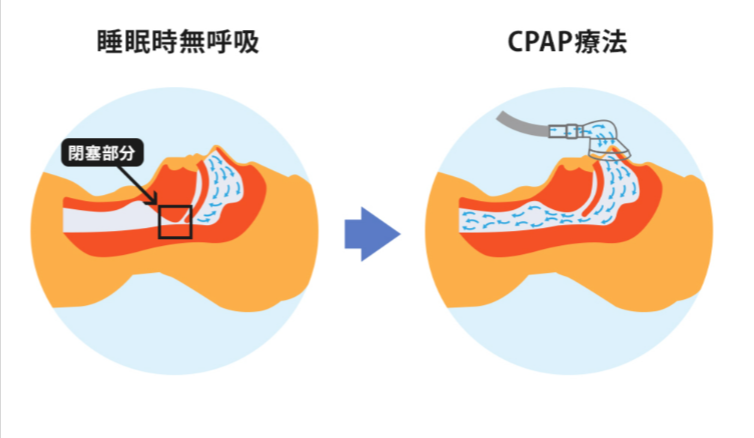 睡眠時無呼吸症候群とは